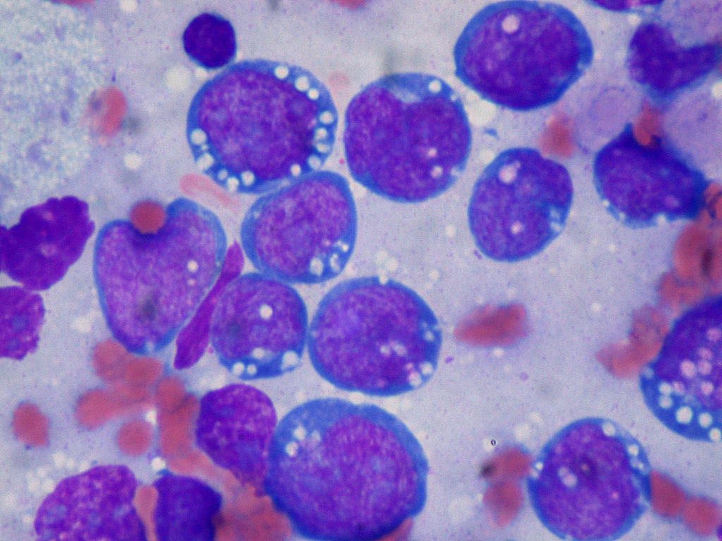 Burkitt lymphoma, the first link of c-Myc to cancer https://www.flickr.com/photos/euthman/144136197/in/set-72057594114099781/ - Credit: Ed Uthman