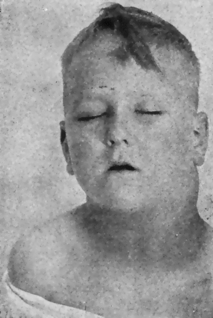 Figure 2. Young child with swollen lymph node (Public Domain).