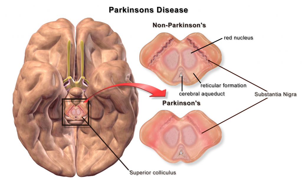 Blausen_0704_ParkinsonsDisease