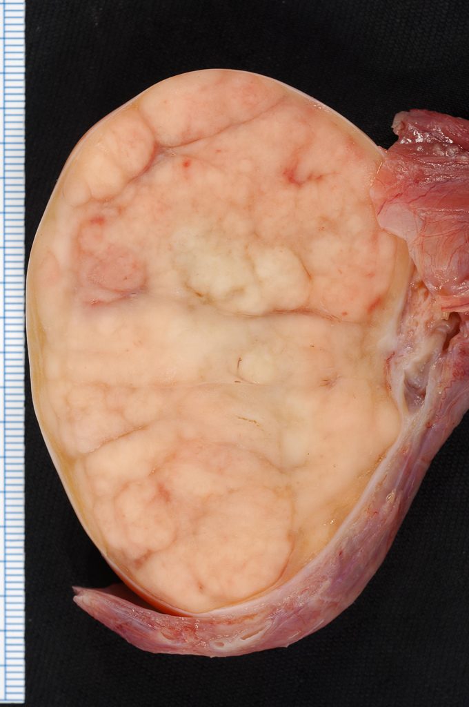 Figure 1. Cancerous Testicle. (Creative Commons)